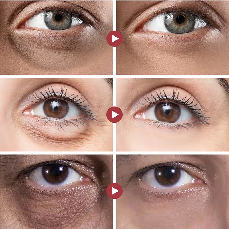 Creme antiolheiras para os olhos